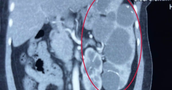 53-year-old woman had pain in the left hypochondrium and went to the doctor and was surprised to discover a 'huge' splenic cyst.