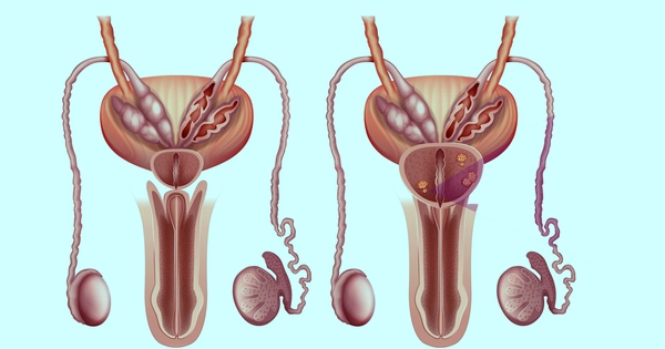 Ist bei einer Prostatavergrößerung eine Operation erforderlich?