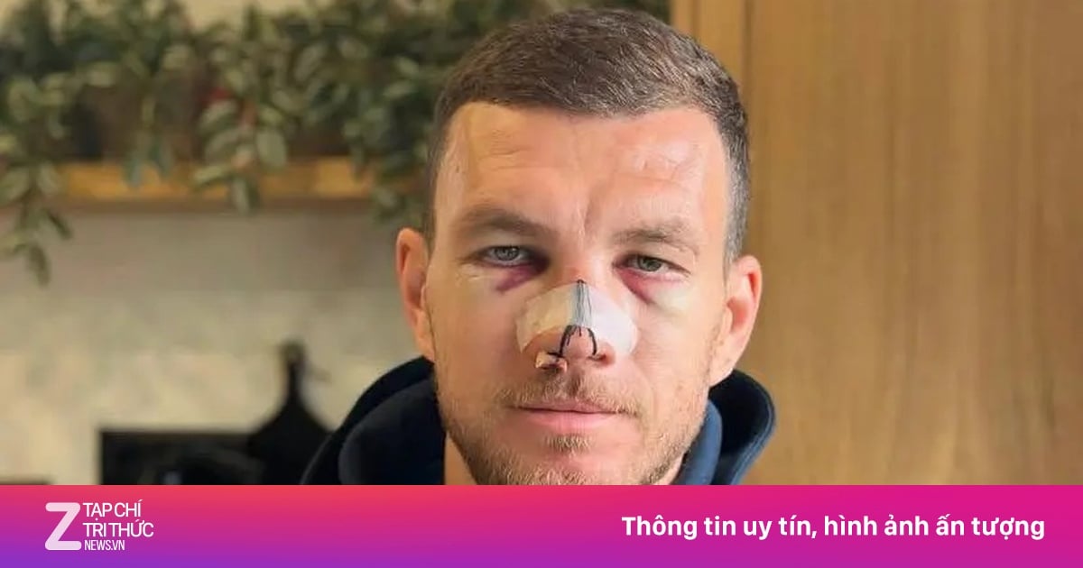 Dzeko's face was bruised.