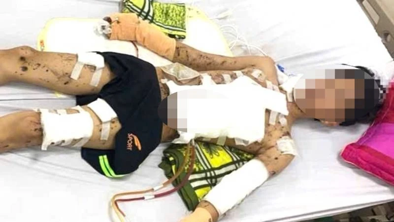 A student in Quang Binh was seriously injured by homemade firecrackers.