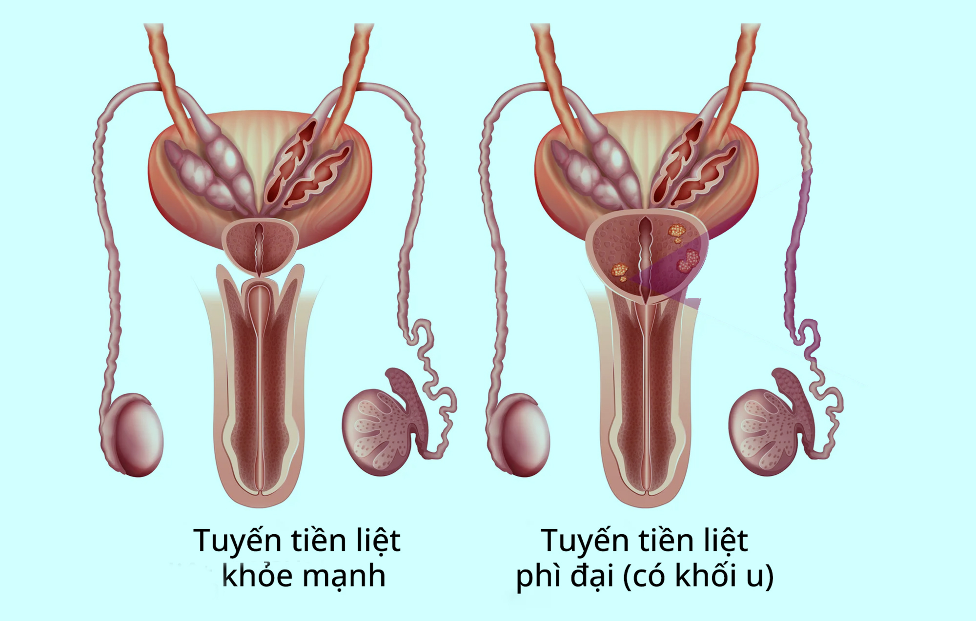 Phì đại tuyến tiền liệt có cần phẫu thuật?- Ảnh 1.