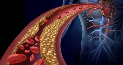 Les maladies cardiovasculaires ont tendance à être plus jeunes.