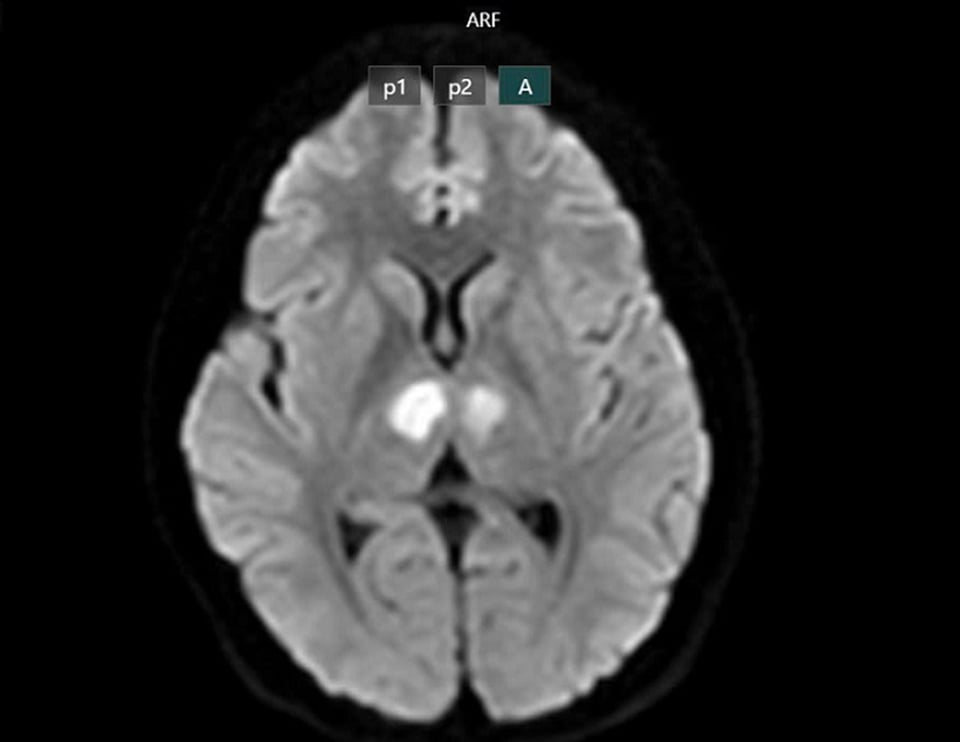 Phim chụp cho thấy não bệnh nhân bị tổn thương vùng đồi thị hai bên.