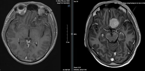 Première intervention endoscopique sur l'arcade sourcilière pour retirer une tumeur de la base antérieure du crâne, photo 1