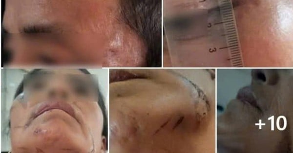 Golpeado y colgado de un árbol bajo sospecha de lanzar hechizos que causaron la muerte de otra persona