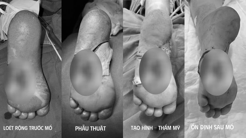 Hình ảnh bàn chân bệnh nhân sau khi được phẫu thuật. Ảnh: Thanh Thanh