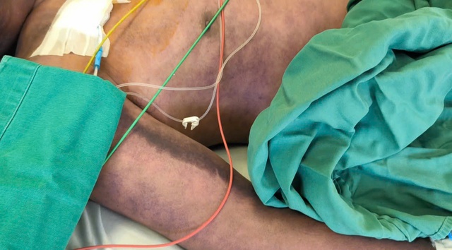 連鎖球菌感染症により危篤状態の男性 - 写真1。