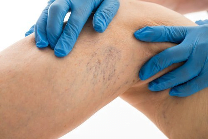医療従事者は静脈瘤になりやすい - 写真 1。