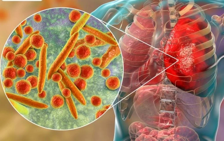 Les bactéries Mycoplasma attaquent le système respiratoire du corps.