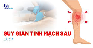 Bị suy giãn tĩnh mạch sâu nhưng phải đi làm liên tục, nên chữa thế nào?
