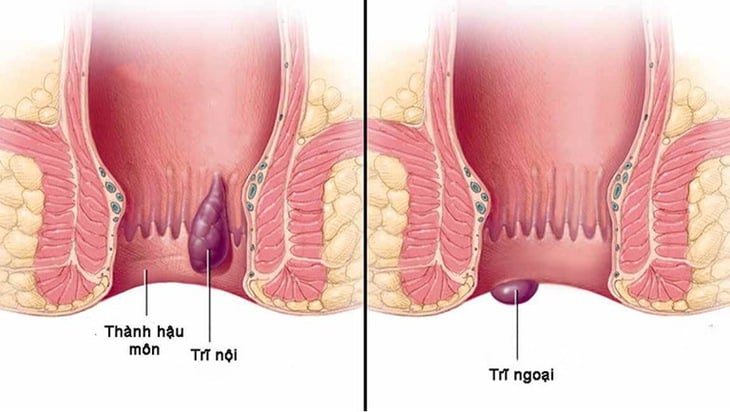 bệnh trĩ - Ảnh 1.