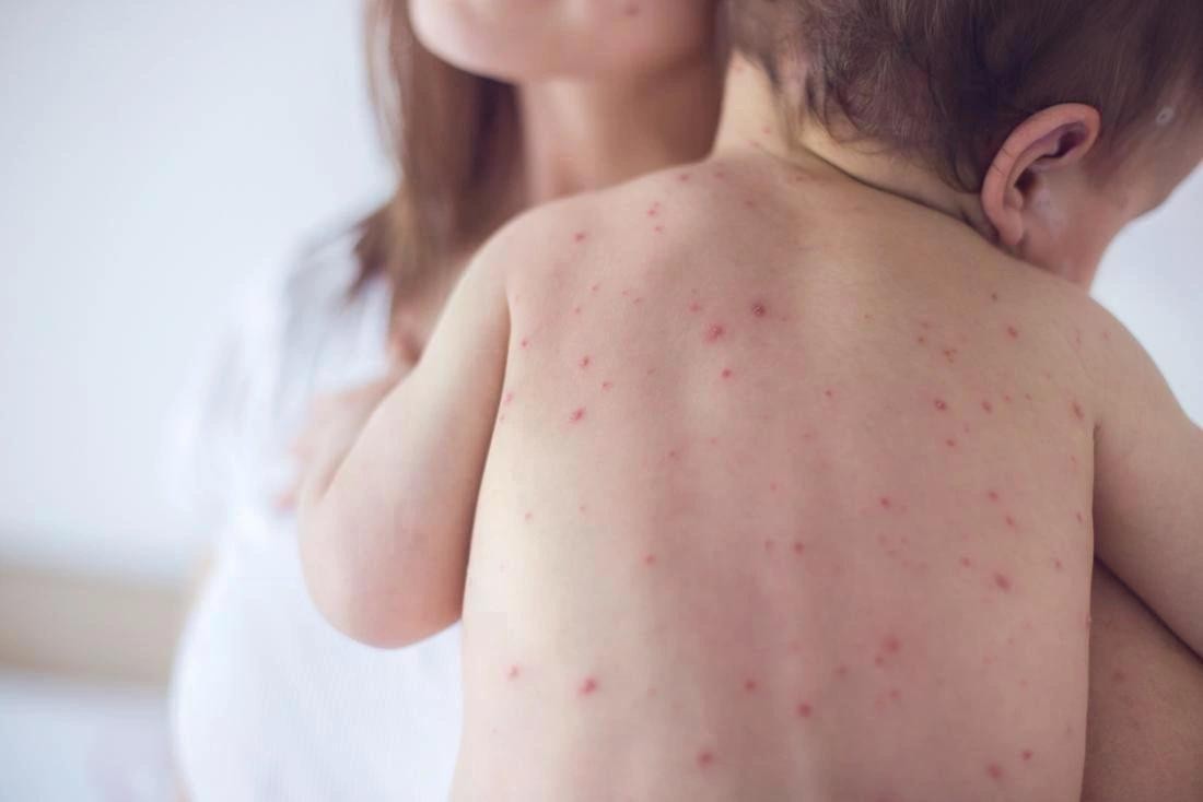 Nếu trong điều kiện không có biến chứng, các bậc phụ huynh có thể dễ dàng chăm sóc trẻ mắc sởi tại nhà.