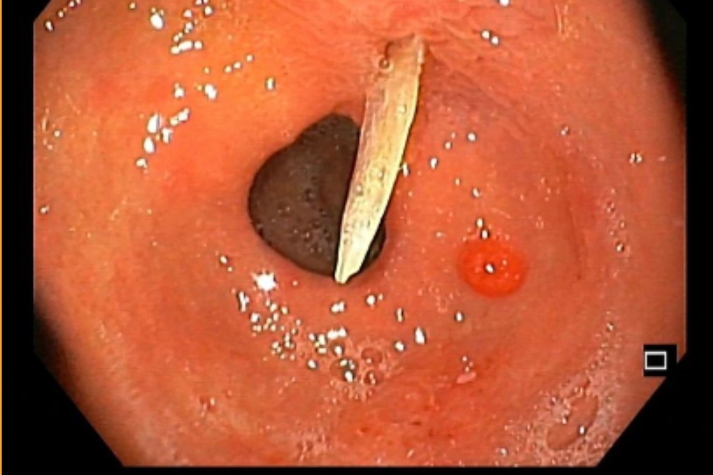 79세 환자의 배에 4cm 길이의 생선가시가 찔려 - 1
