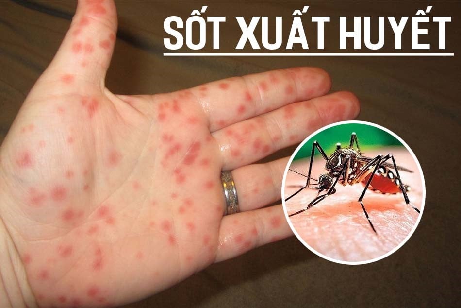 Urgently implement epidemic prevention measures during the transitional season