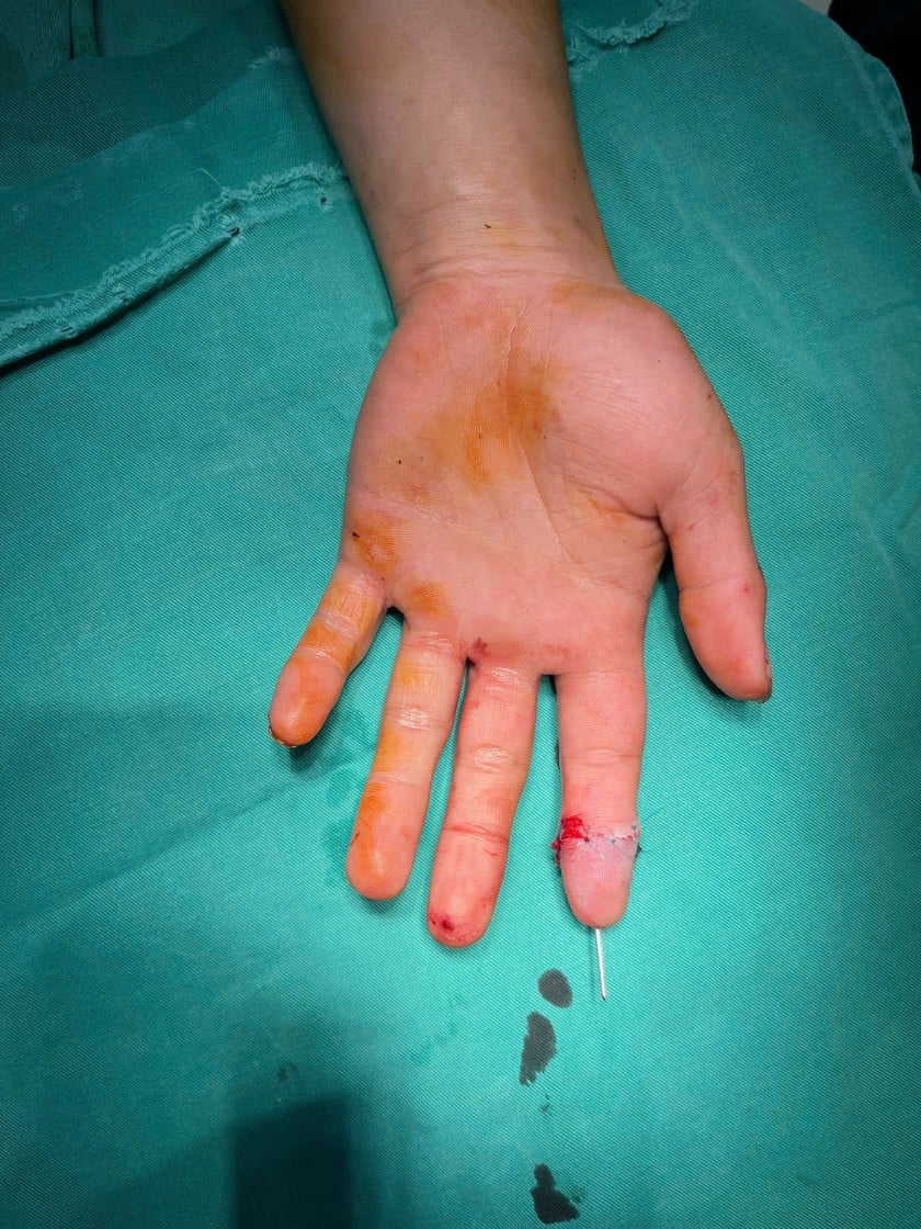 Sau 14 ngày, ngón trỏ của bệnh nhân bắt đầu hồi phục tích cực. Ảnh: Thanh Thanh