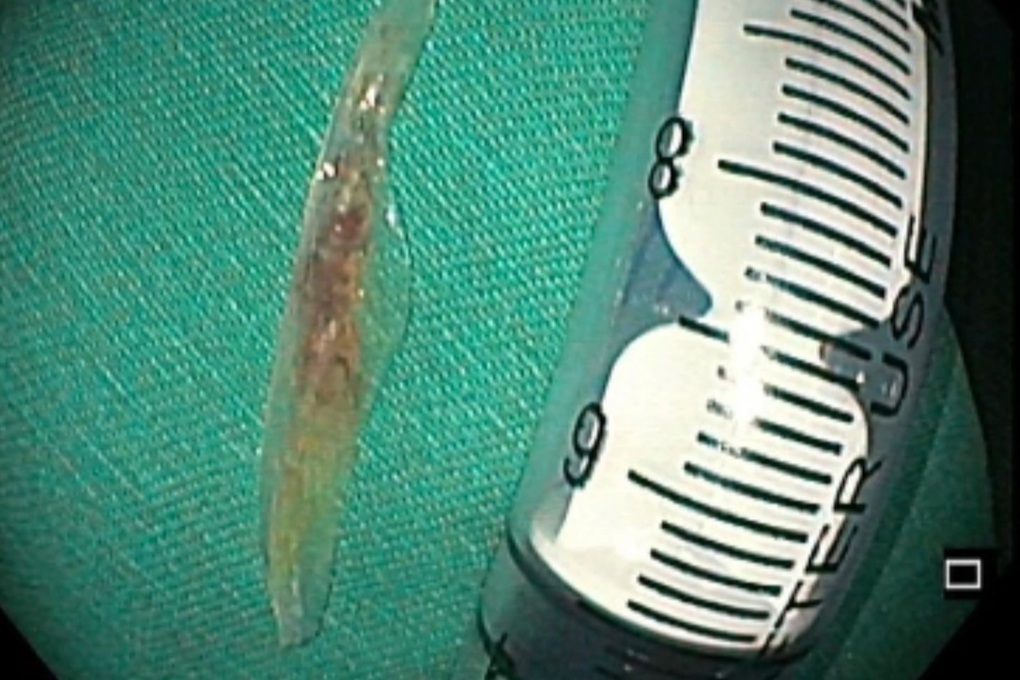 79세 환자, 배에 4cm 생선뼈 찔려 - 2