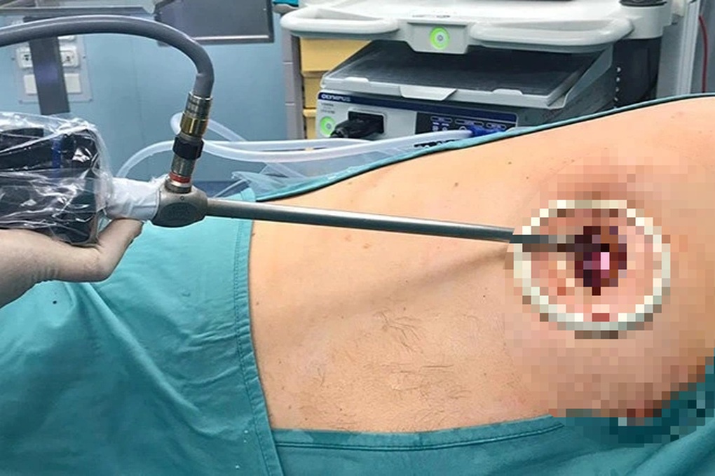 HCMC: A healthy 27-year-old man suddenly had drooping eyelids, facing death - 2