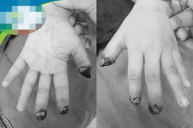 Reimplantación de 3 dedos amputados en paciente de 5 años, foto 1