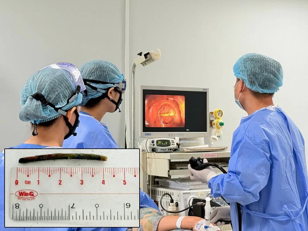 Các bác sĩ Bệnh viện Hoàn Mỹ Đồng Nai gắp dị vật cho bà H. Ảnh nhỏ: Dị vật được lấy ra. Ảnh: BVCC