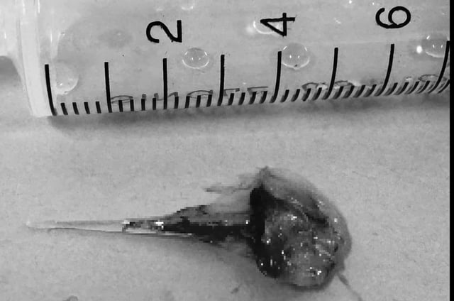 Ho nhiều ngày, đi khám phát hiện mảnh xương cá dài 6 cm trong phế quản - Ảnh 1.