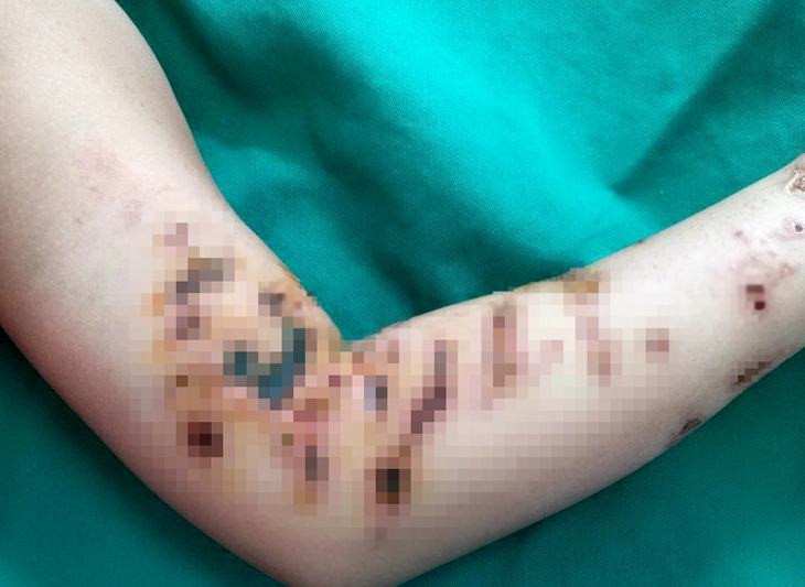 Badesaison, Vorsicht vor Feuerquallen – Foto 1.