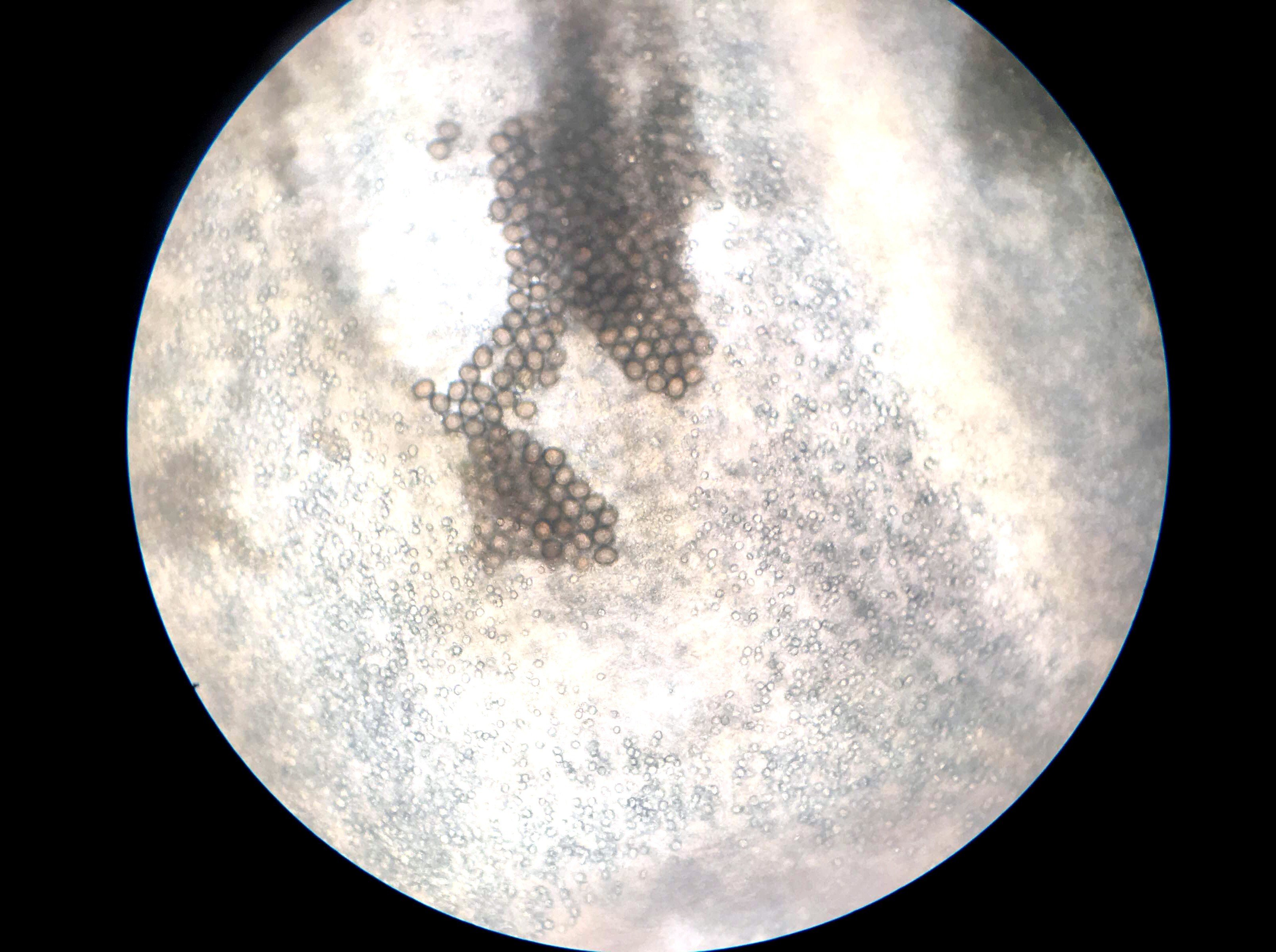large-bowel-infection-from-eating-blood-soup