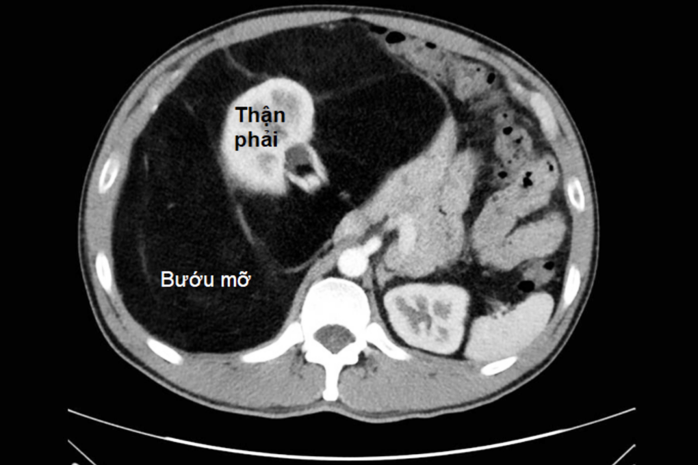 Nhiều người suýt chết vì tưởng bụng bia - 1