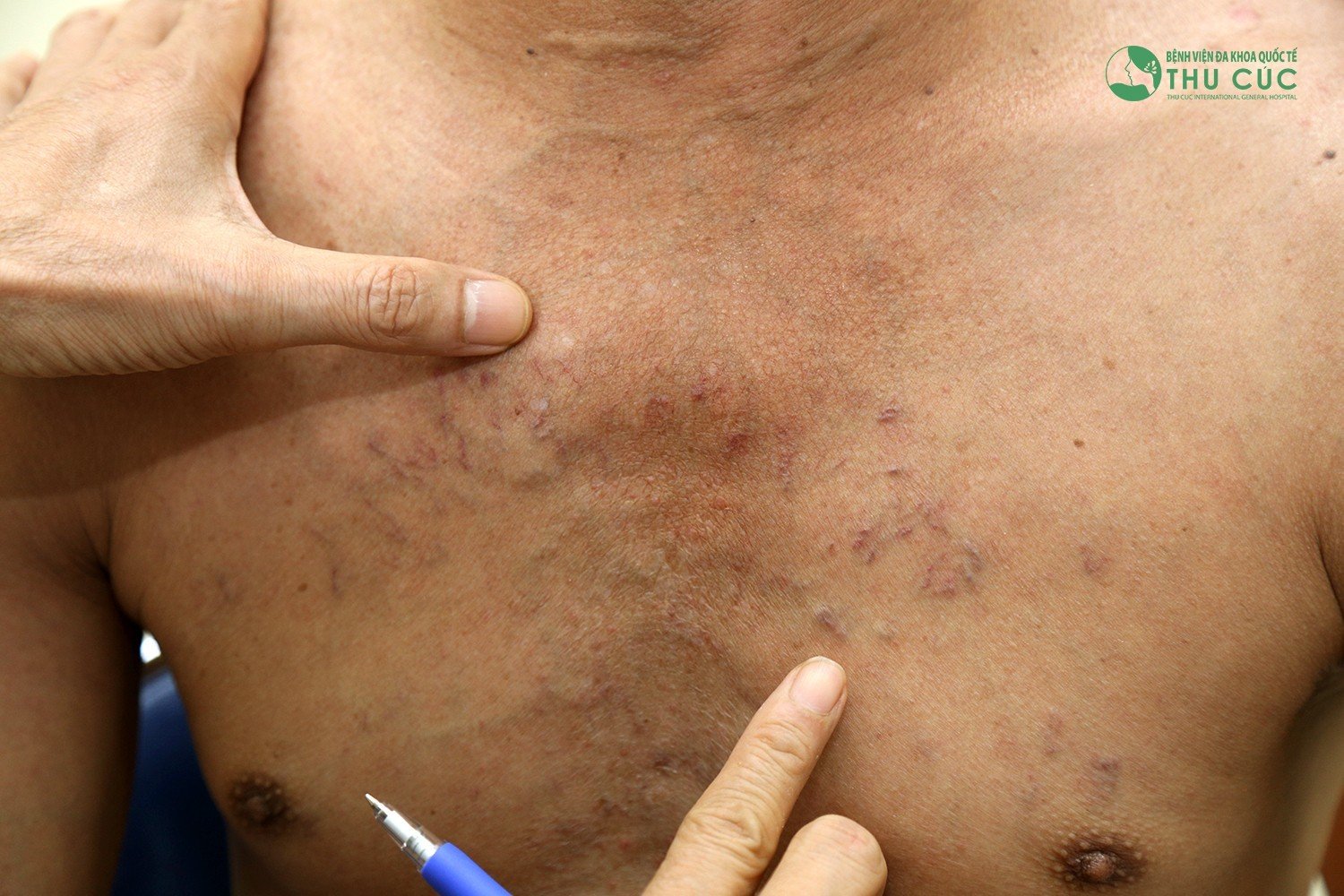 large-bowel-infection-from-eating-blood-soup