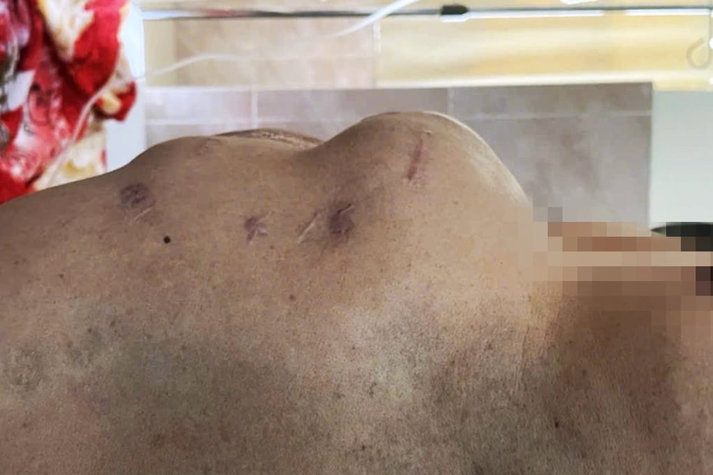 Nhiều người suýt chết vì tưởng bụng bia - 3