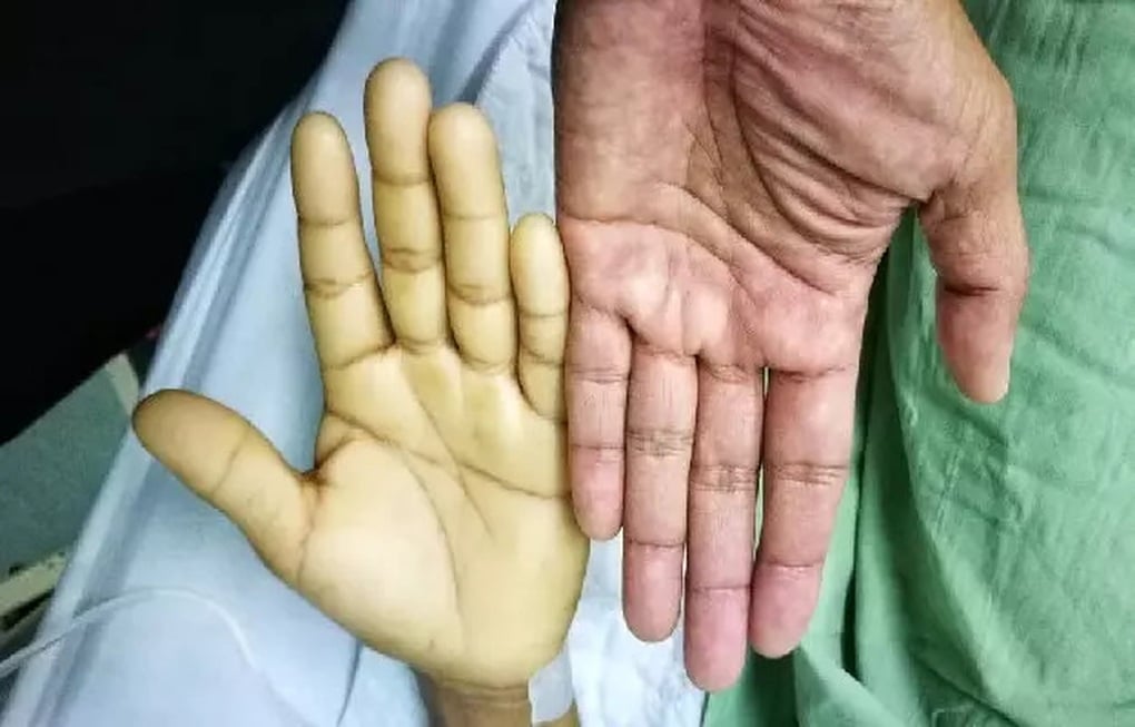 Hiểu lầm phổ biến về sữa của cha mẹ khiến bé 3 tuổi phải truyền máu - 1
