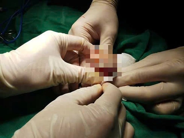 cáncer de pene