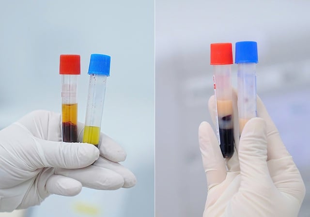 Đi khám thấy huyết thanh đục như sữa, dấu hiệu cảnh báo nguy cơ đột quỵ ở người trẻ - Ảnh 1.