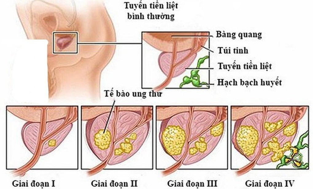 Căn bệnh ung thư cựu Tổng thống Mỹ Joe Biden mắc phải nguy hiểm thế nào? - 2