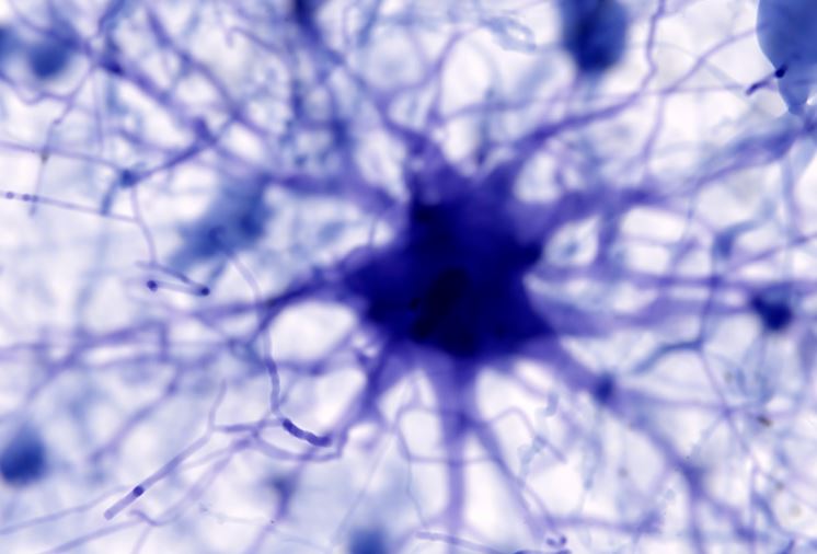 AI រកឃើញមូលហេតុនៃជំងឺ Alzheimer និងអាចស្វែងរកការព្យាបាល