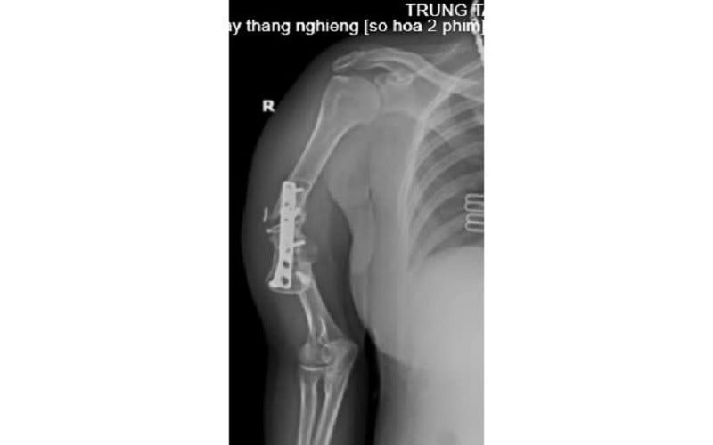 Tình trạng bệnh nhân trước khi mổ.