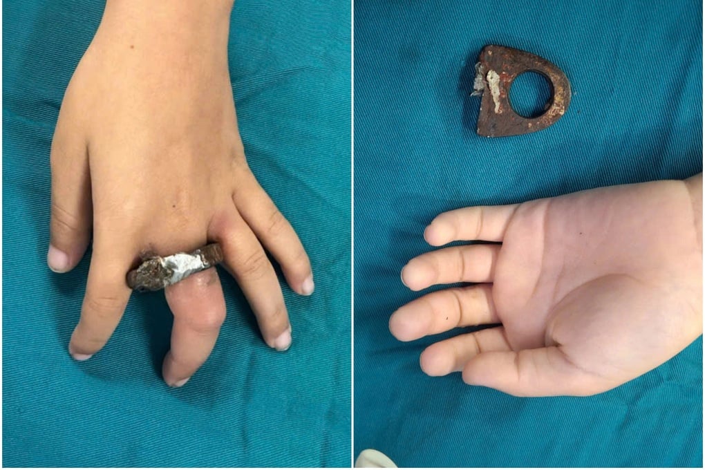 Hà Nội: Gia đình cưa cổng giải cứu bé trai kẹt tay trong vòng khóa - 1
