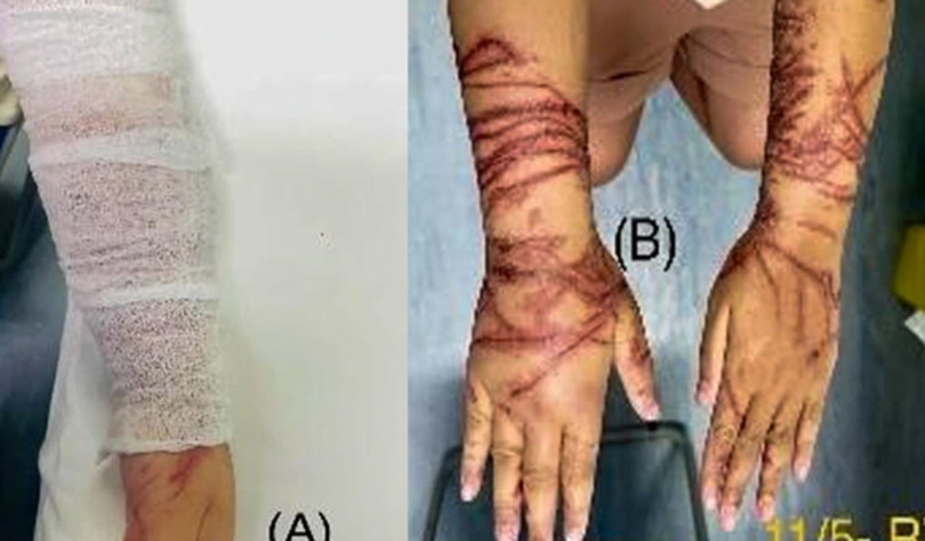 Vòng tay ôm sứa biển trong suốt, bé gái bị bỏng rát chằng chịt 2 cẳng tay - 2