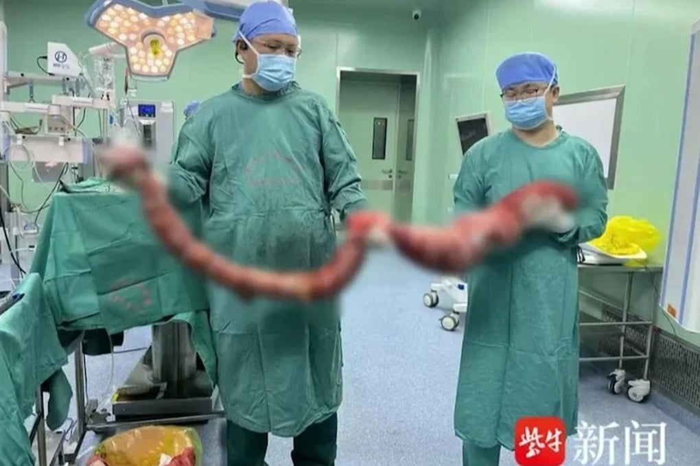 Không đại tiện 4 tháng, người đàn ông được mổ lấy khối ruột nặng 20kg - 1