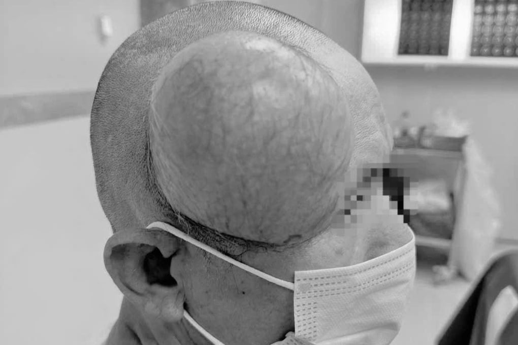 Khối u khổng lồ mọc trên đầu người đàn ông ở Đắk Lắk - 1