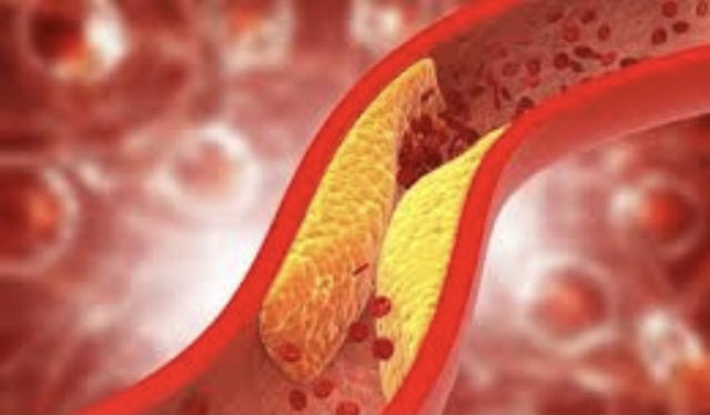 Chuyên gia: 2 bài tập tốt nhất chỉ 30 phút để giảm cholesterol xấu - Ảnh 1.