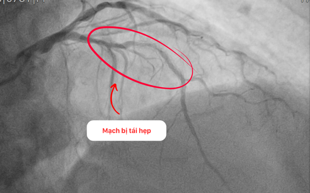 Can thiệp thành công cho bệnh nhân tái hẹp nặng mạch vành sau 15 năm đặt stent - 1