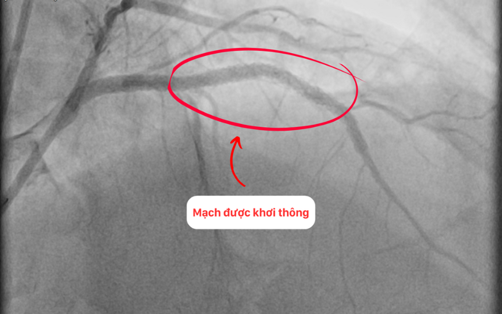 Can thiệp thành công cho bệnh nhân tái hẹp nặng mạch vành sau 15 năm đặt stent - 3