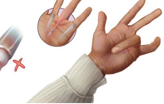 Bác sĩ: Hội chứng 'Ngón tay lò xo' là gì? - Ảnh 1.
