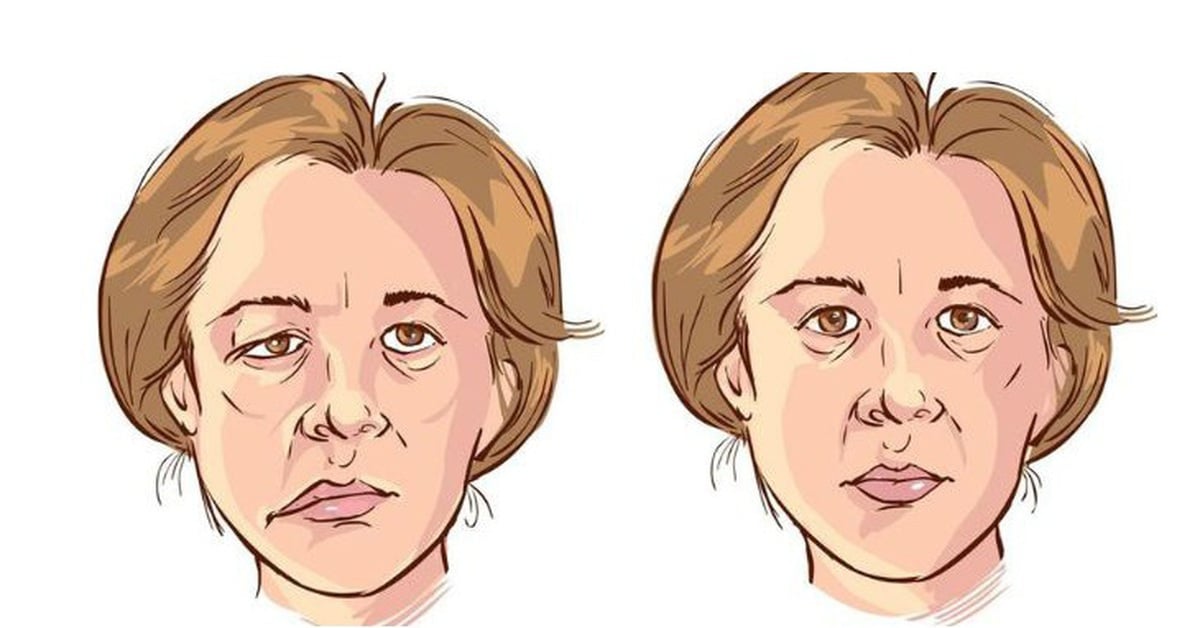 Nhiễm lạnh, trúng gió: Nguy cơ dẫn đến liệt dây thần kinh số 7 ngoại biên