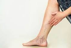 Suy giãn tĩnh mạch chân có nên đi bộ không?