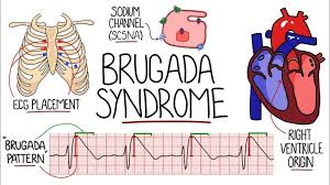 Hội chứng Brugada nên đi khám ở đâu?