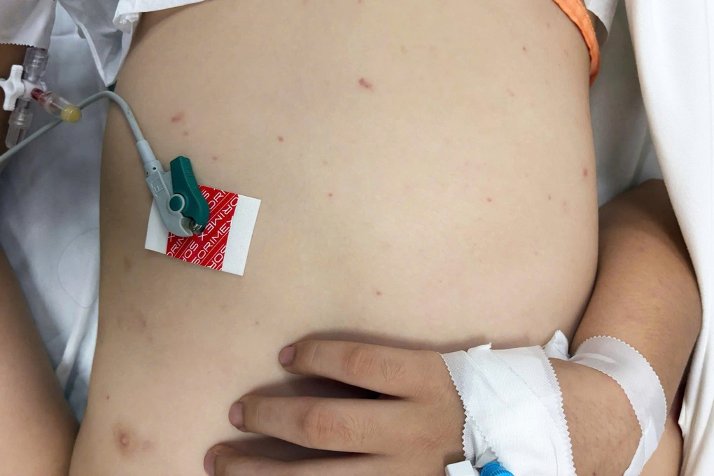 Bé trai 13 tuổi bỗng đau đầu dữ dội vì bệnh hiểm ở não dễ lây qua giọt bắn - 2