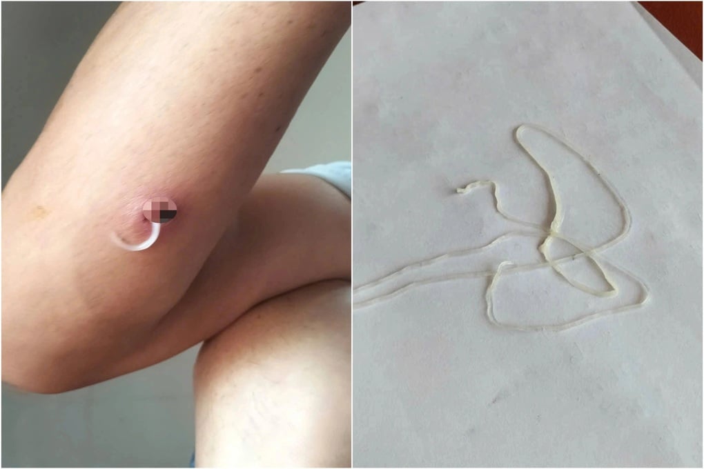 Cảnh báo: Nhiễm giun rồng nguy hiểm do ăn món đặc sản gỏi cá - 1