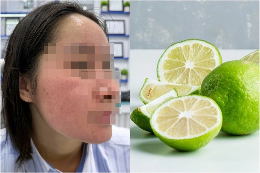 Bôi chanh lên mặt trị mụn theo hội nhóm Facebook, thiếu nữ mặt nở hoa - 1