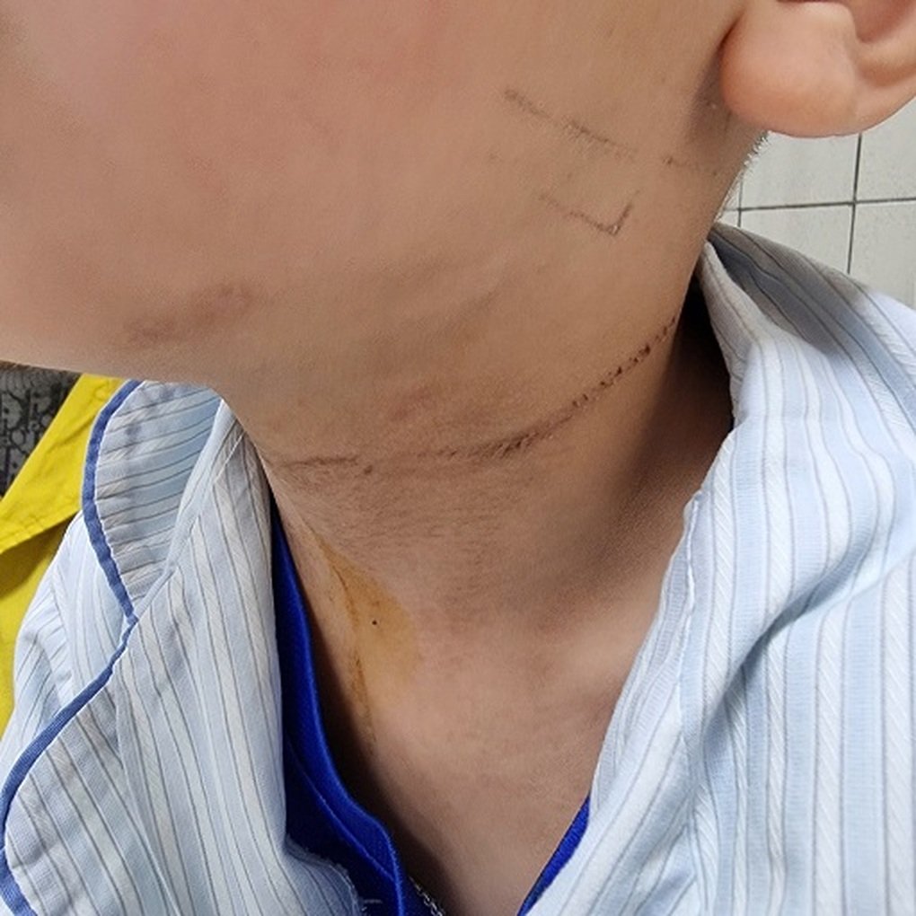 Bé 5 tuổi nghịch dây quần áo, bị dây thắt vào cổ - 1